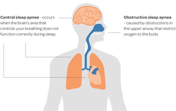 Illustration on the organs of the body affected by two types of sleep apnea